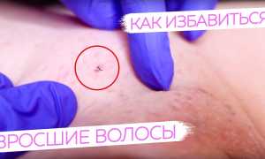 Профилактика вросших волос: советы и рекомендации