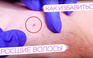 Профилактика вросших волос: советы и рекомендации