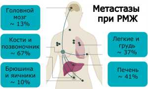 Метастазы при раке груди — прогноз и лечение