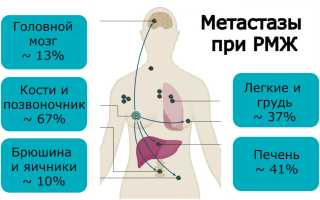 Метастазы при раке груди — прогноз и лечение