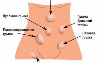 Как болит грыжа живота: симптомы, диагностика и лечение