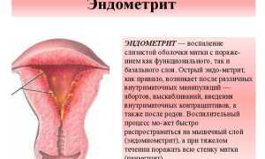 Эндометрит — симптомы и лечение, важные аспекты
