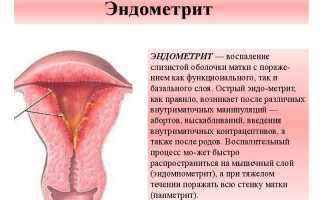 Эндометрит — симптомы и лечение, важные аспекты