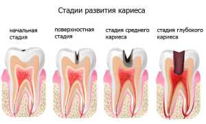 Как развивается кариес зубов: стадии и этапы его формирования