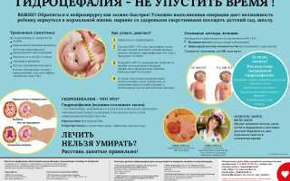 Как понять, что у новорожденного гидроцефалия? Полезные советы для родителей