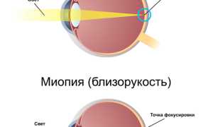Что такое близорукость и как восстановить зрение естественными методами?
