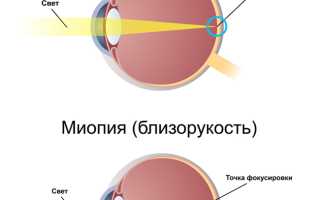 Что такое близорукость и как восстановить зрение естественными методами?