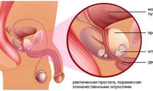 Рак простаты с метастазами в кости: прогноз жизни, лечение и рекомендации