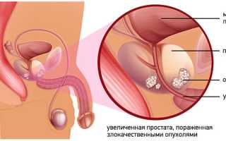 Рак простаты с метастазами в кости: прогноз жизни, лечение и рекомендации