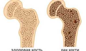 Как проявляется рак костного мозга? Симптомы и диагностика