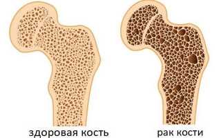Как проявляется рак костного мозга? Симптомы и диагностика