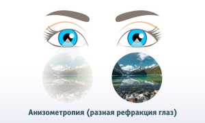 Анизометропия: что это такое и как лечится? Полное руководство