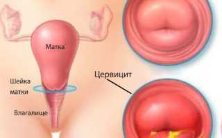 Цервицит у женщин — причины и варианты лечения, советы специалистов