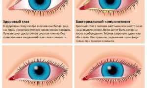 Может ли от конъюнктивита упасть зрение: ответ офтальмолога и рекомендации