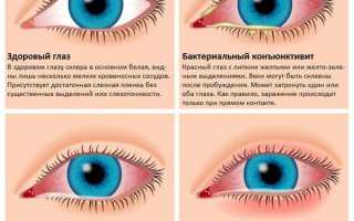 Может ли от конъюнктивита упасть зрение: ответ офтальмолога и рекомендации