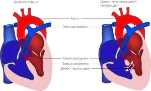Что важно знать о дефекте межпредсердной перегородки у ребенка? Полезные советы и рекомендации