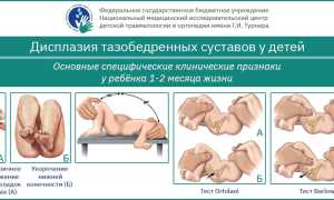 Вывих (дисплазия) тазобедренного сустава у новорожденных: причины, лечение и профилактика