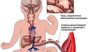 Как может случиться внутриутробная гипоксия плода и чем это грозит для здоровья