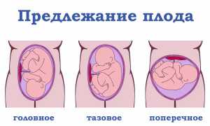 Беременность и тазовое предлежание плода: чем это опасно для здоровья