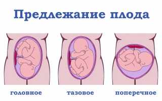Беременность и тазовое предлежание плода: чем это опасно для здоровья