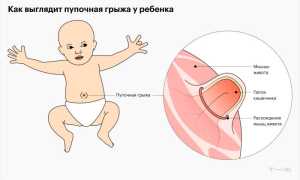 Что делать, если кровоточит пупок у новорожденного? Полезные советы для родителей