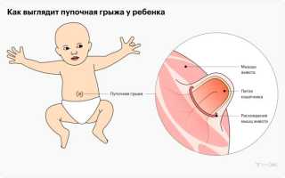 Что делать, если кровоточит пупок у новорожденного? Полезные советы для родителей