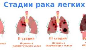 Как протекает рак легких на 3 стадии? Полное руководство