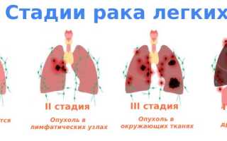Как протекает рак легких на 3 стадии? Полное руководство