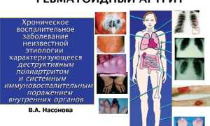 Почему нельзя болеть гриппом, если у вас ревматоидный артрит. Обязательна ли прививка для здоровья?