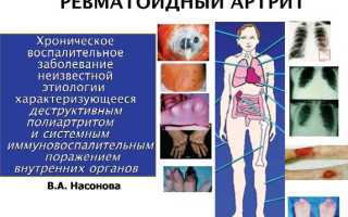 Почему нельзя болеть гриппом, если у вас ревматоидный артрит. Обязательна ли прививка для здоровья?