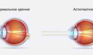 Астигматизм: причины, симптомы и лечение