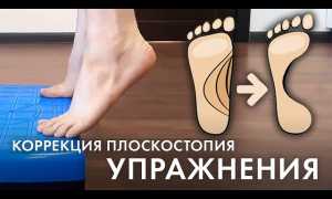 Как исправить плоскостопие взрослому: полезные упражнения для здоровья