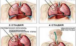Рак легких с метастазами — всё, что нужно знать для понимания болезни