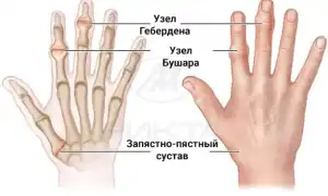 Воспаление суставов пальцев рук: в чем причина и как лечить?
