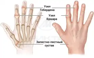 Воспаление суставов пальцев рук: в чем причина и как лечить?