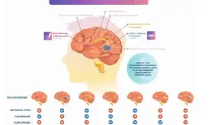 Как проявляется речевая афазия? Полное руководство