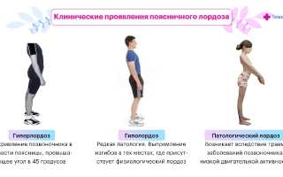 Лордоз — что это значит и как с ним жить?