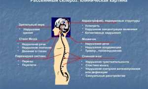 Боли в мышцах — как главный признак рассеянного склероза и его последствия