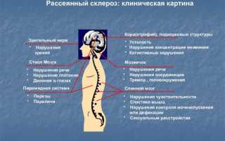 Боли в мышцах — как главный признак рассеянного склероза и его последствия