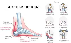 Плантарный (подошвенный) фасциит: причины, симптомы и лечение для здоровья стоп