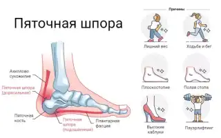Плантарный (подошвенный) фасциит: причины, симптомы и лечение для здоровья стоп