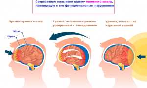Как долго проходит сотрясение мозга? Узнайте важные факты