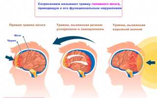 Как долго проходит сотрясение мозга? Узнайте важные факты