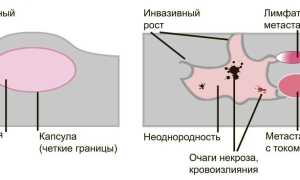 Чем отличается доброкачественная опухоль от злокачественной? Важные аспекты