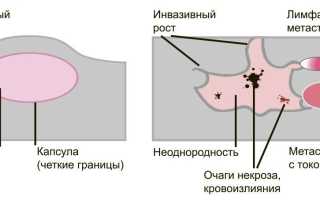 Чем отличается доброкачественная опухоль от злокачественной? Важные аспекты