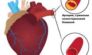 Повышенный холестерин после COVID-19: почему это происходит и что с этим делать?