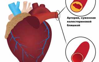 Повышенный холестерин после COVID-19: почему это происходит и что с этим делать?