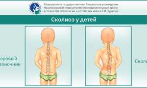 Сколиоз у школьников: почему возникает и как его лечить? Полезные советы