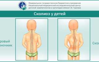 Сколиоз у школьников: почему возникает и как его лечить? Полезные советы