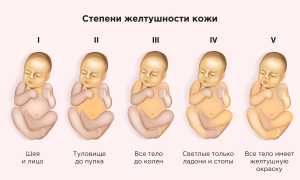 Желтуха у младенцев: почему возникает, что делать и как помочь?